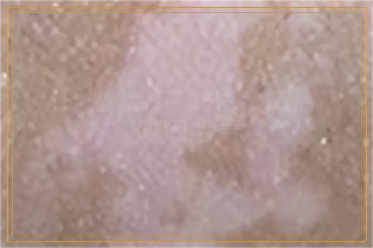 为什么小孩子的白癜风治疗一段时间后更大了