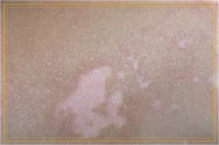 一平方厘米白癜风做308激光多少钱