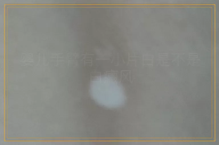 婴儿手臂有一小片白是不是白癜风