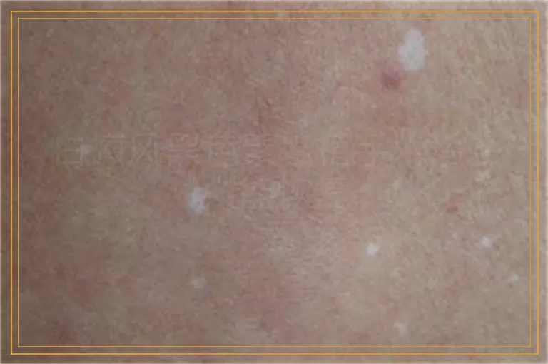 白癜风黑色素培植手术后多久能恢复