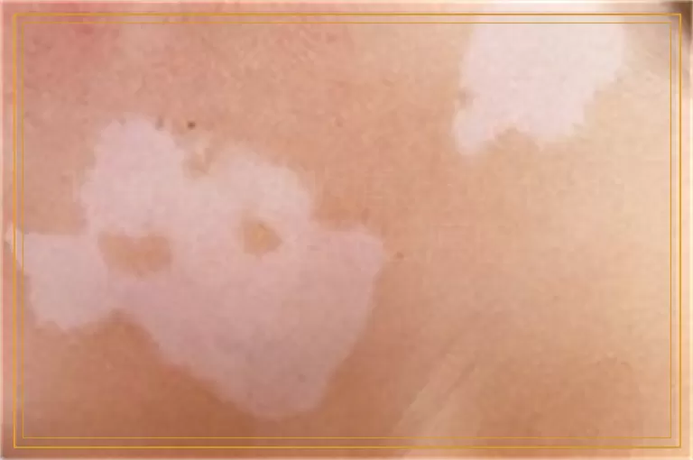 嘴角旁边和嘴唇上边有一块白斑是什么原因