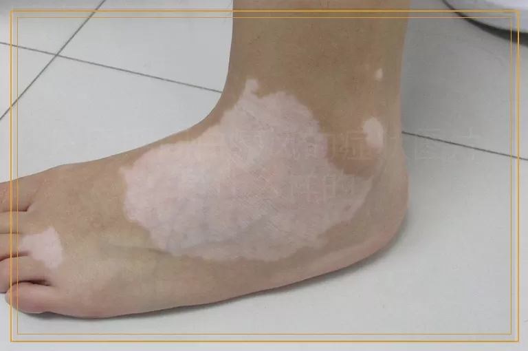 发展期间白癜风的症状图片是什么样的