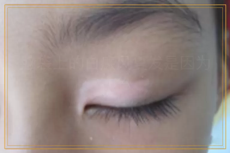 脑袋上的白癜风复发是因为什么