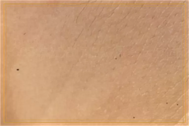 308激光治疗白癜风多长时间见效