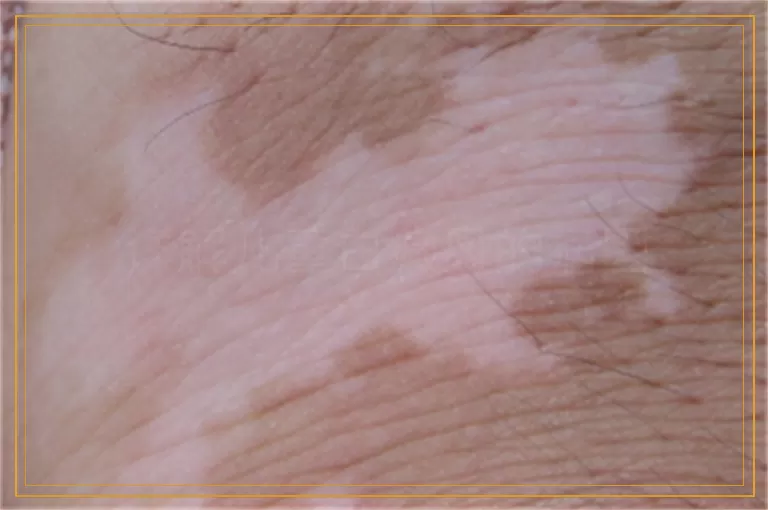 详解儿童白癜风的病因