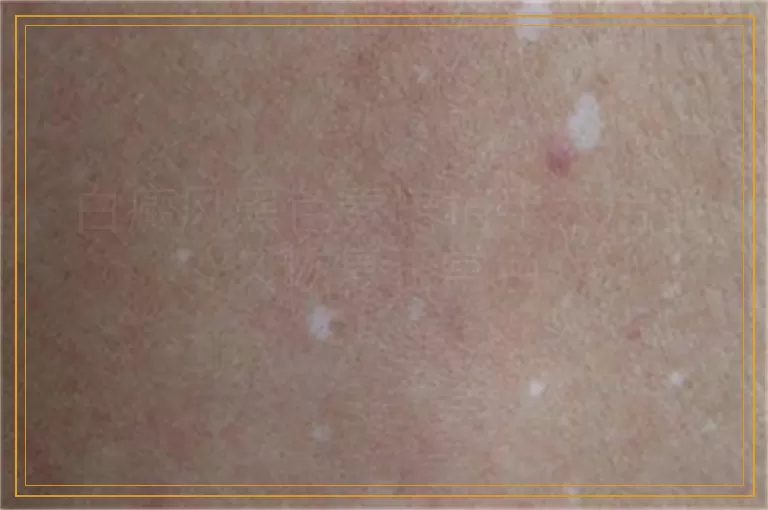 白癜风黑色素培植手术后多久恢复正常色