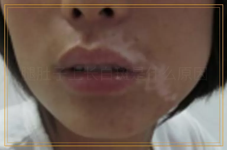 腿肚子上长白斑是什么原因