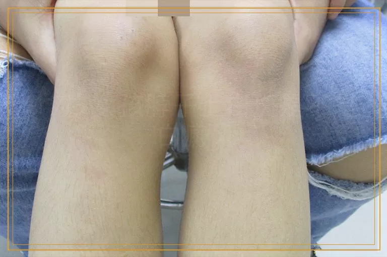 17岁女孩脖子上白斑是不是白癜风