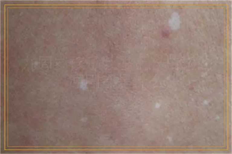 九周岁孩子肚子上长白斑的原因都是什么