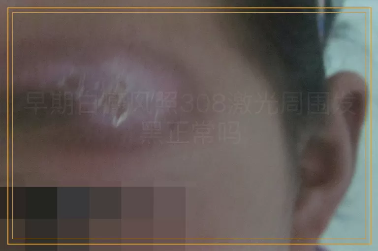 早期白癜风照308激光周围发黑正常吗