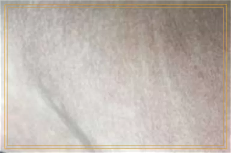 日晒过度皮肤变黑后长了几个小白点是怎么回事