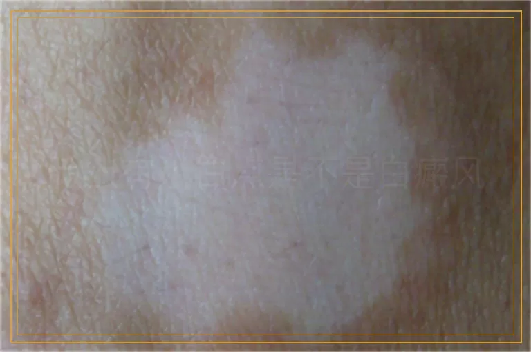 脸上有小白点是不是白癜风