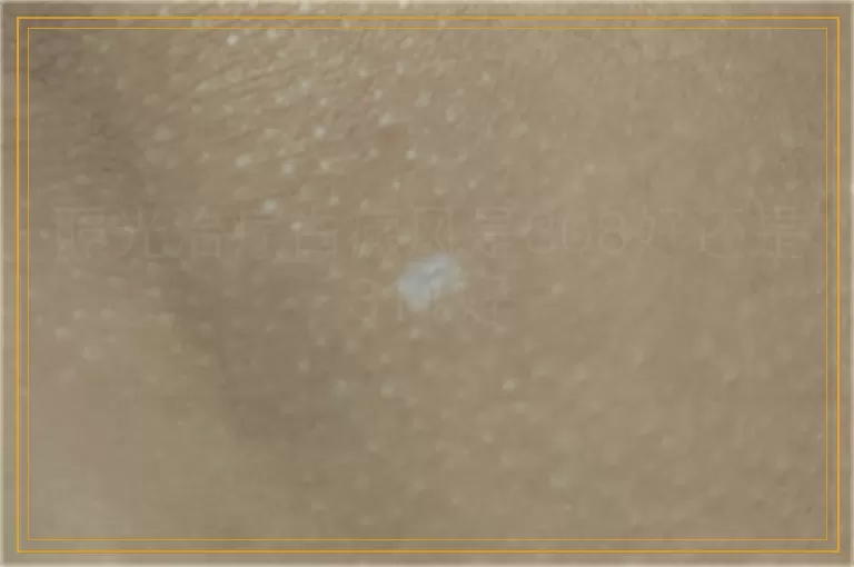 照光治疗白癜风是308好还是311好