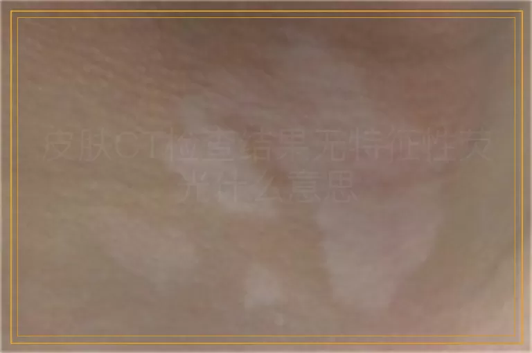 皮肤CT检查结果无特征性荧光什么意思
