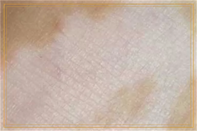 植皮手术治疗白癜风多长时间见效