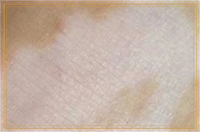 婴儿几天照一次308激光效果比较好