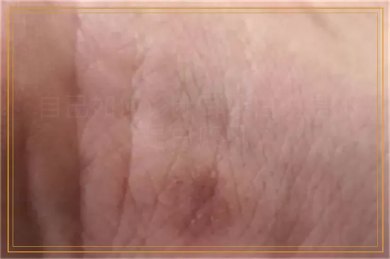 自己如何诊断耳朵白斑是不是白癜风
