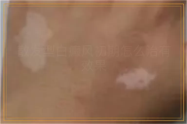 散发型白癜风初期怎么治有效果