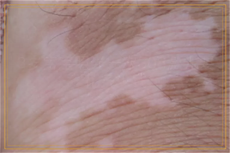 3岁宝宝照光一次308激光要花多少钱