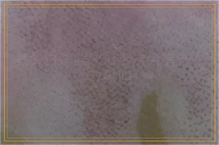 额头白斑照308十次会有什么效果吗