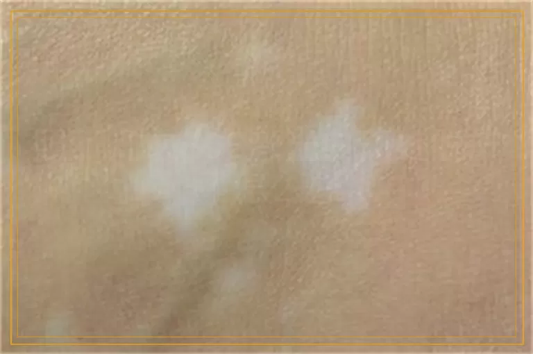 照了几次308激光白斑处脱皮了怎么办