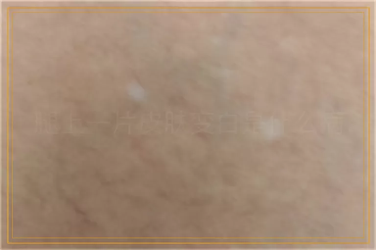 腿上一片皮肤变白是什么病