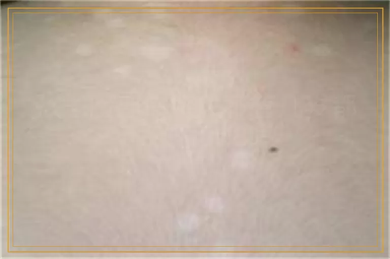 孩子脸部白癜风不管几岁都可以照308吗