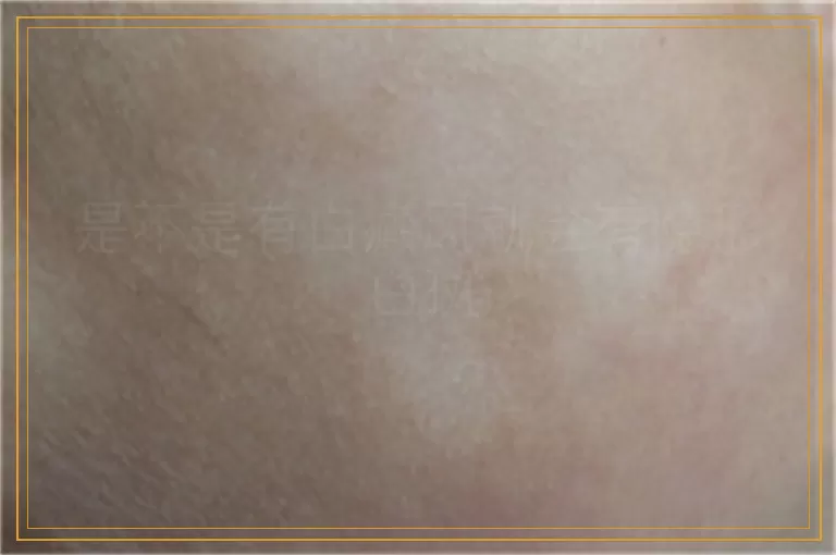 是不是有白癜风就会有隐形白斑