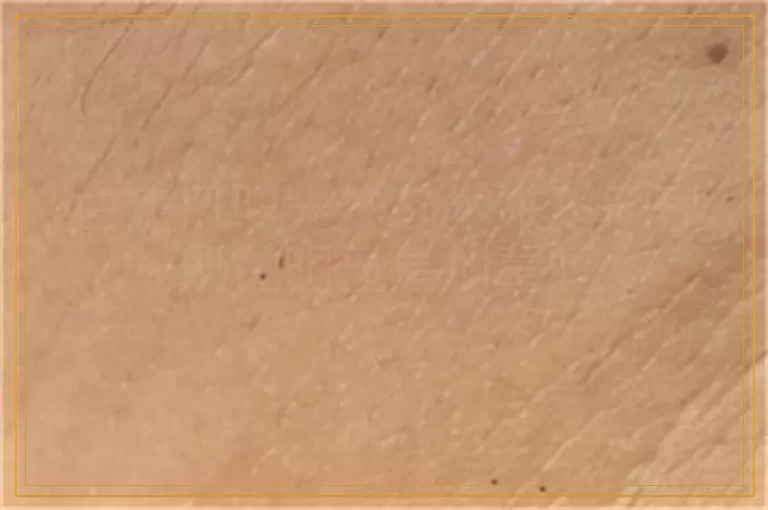 白癜风照光抹药本来不明显现在明显是加重吗