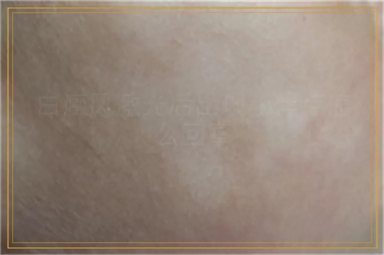 白癜风激光后出现小黑点怎么回事