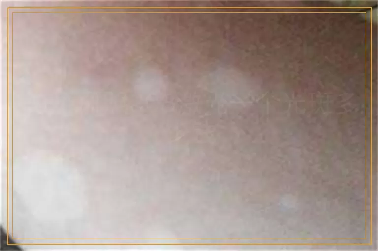 白癜风照308激光一个光斑多少钱