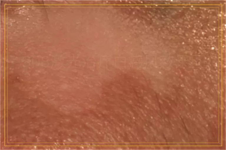 308激光治疗白癜风效果图