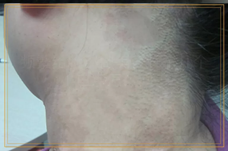 频繁给脸部做美容长了几个小白点怎么回事