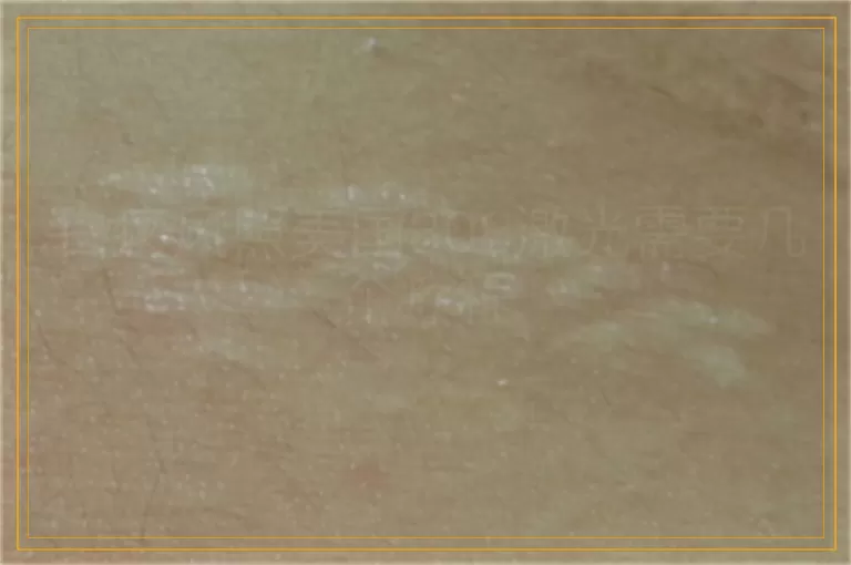 白癜风照美国308激光需要几个疗程