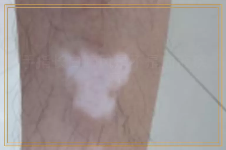 手指长白癜风是不是血液疾病