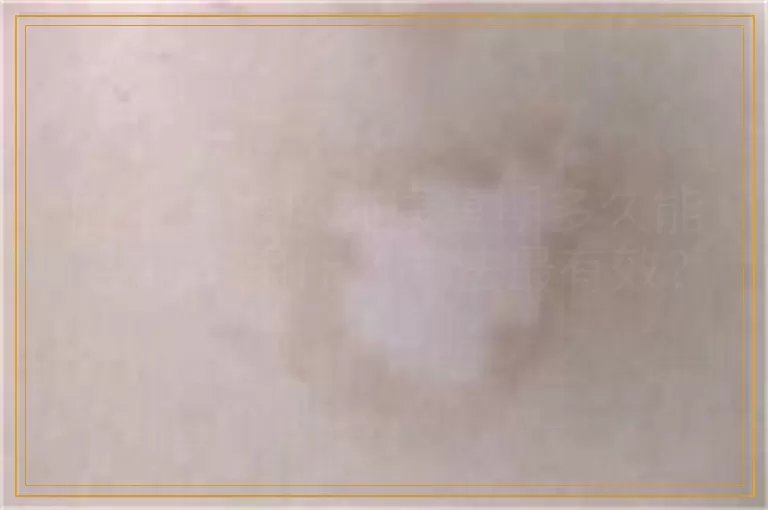 脸上白癜风在康复期多久能控制?用什么方法最有效? 脸上白癜风在康复期多久能控制?用什么方法最有效?