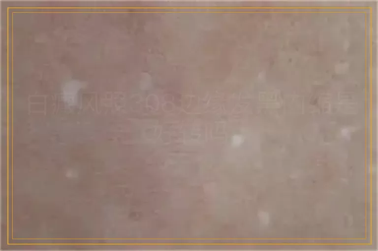 白癜风照308边缘发黑内缩是好转吗