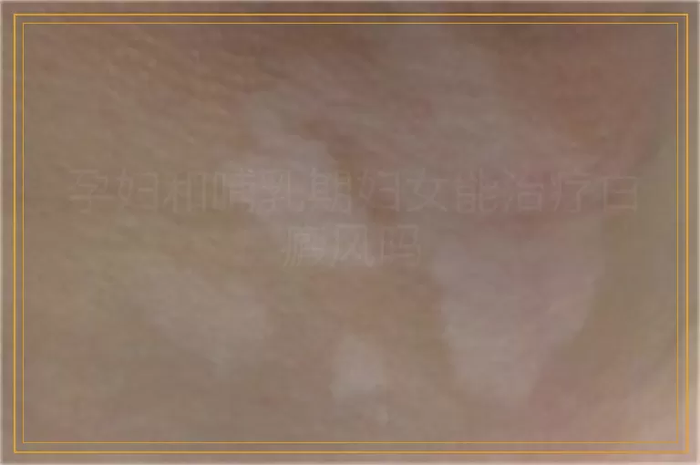 孕妇和哺乳期妇女能治疗白癜风吗