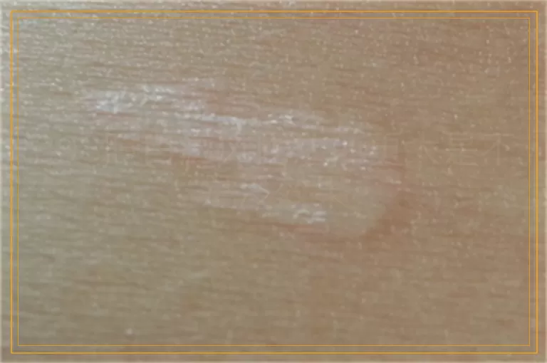 308照白癜风比之前更大是不是没效果