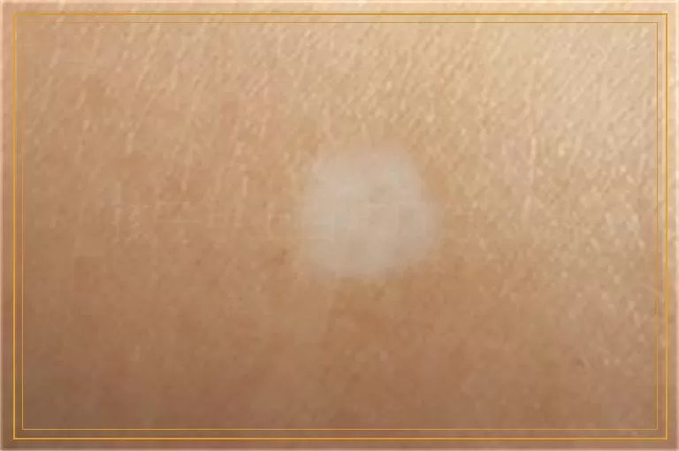 孩子手上白癜风怎么治