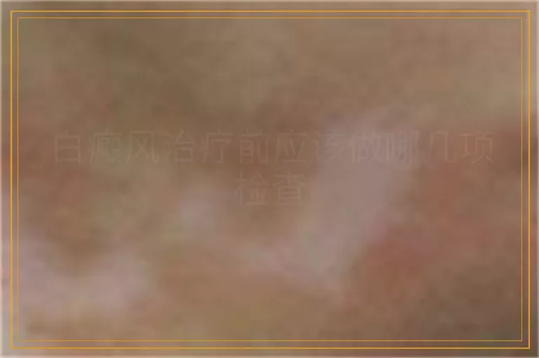 白癜风治疗前应该做哪几项检查