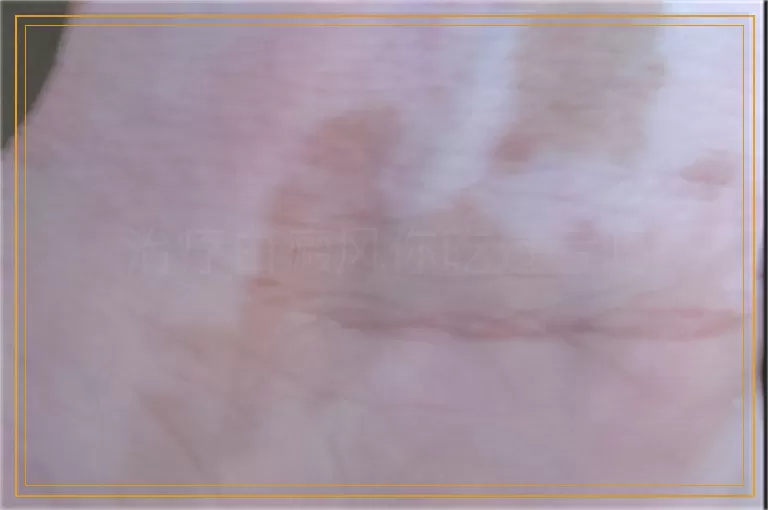 治疗白癜风你吃过亏吗