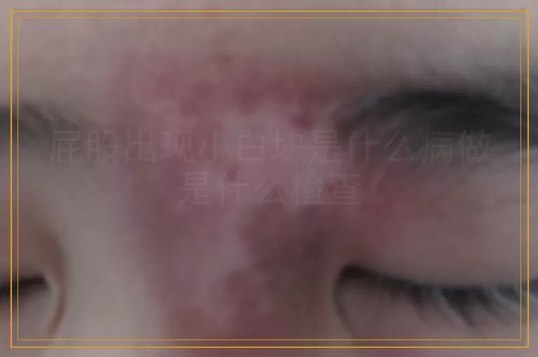 屁股出现小白块是什么病做是什么检查