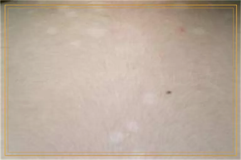 发展期白癜风怎么治比较好