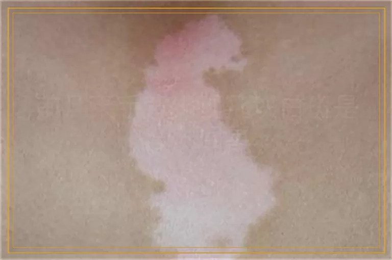 前几天手背出现几块白斑是怎么回事