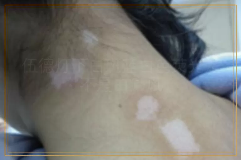 伍德灯下白斑蓝白色荧光是不是白癜风