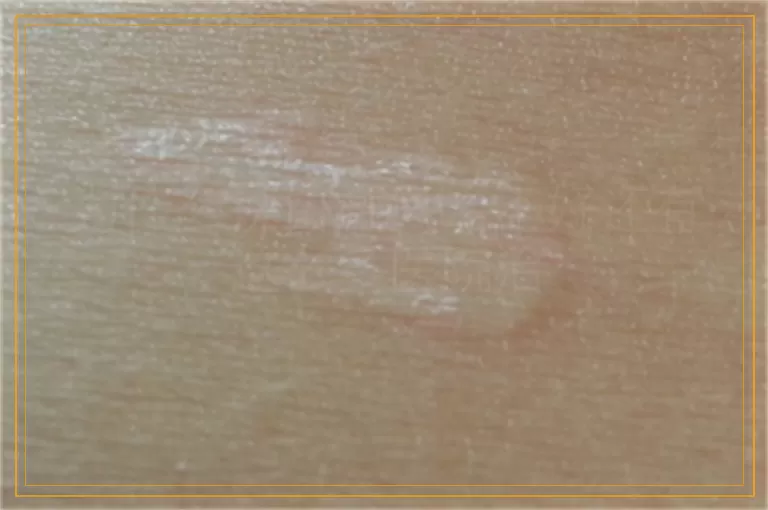 为什么说白癜风治不好还有这么多医院治