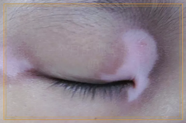 照光一个月出现黑点是好转吗