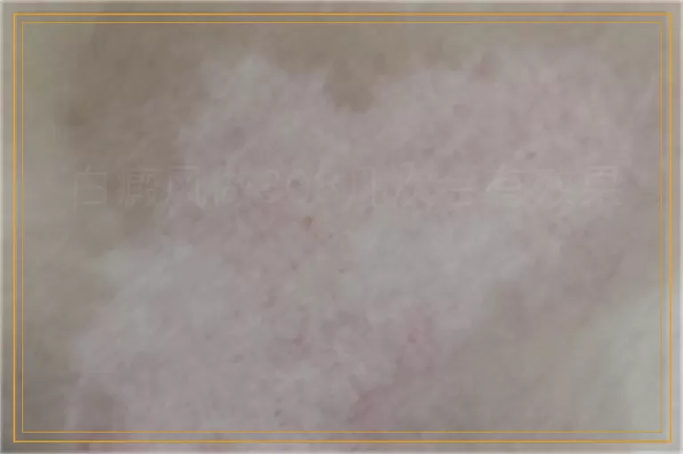 白癜风做308几次会有效果