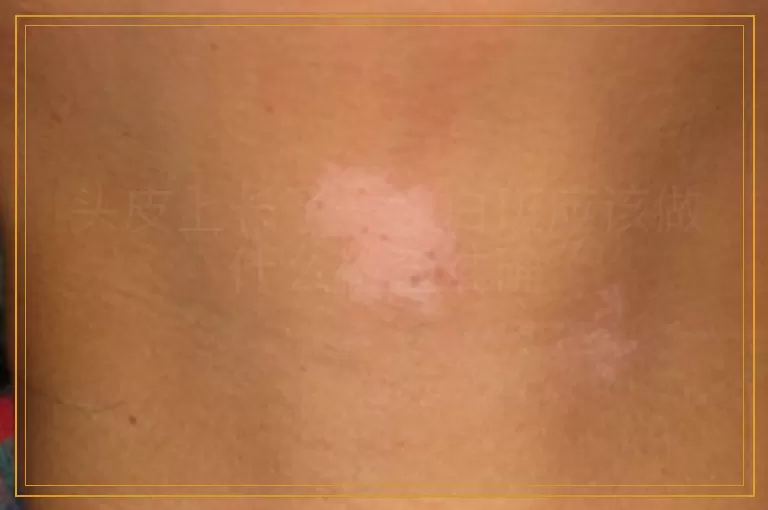 头皮上长了一块白斑应该做什么检查准确